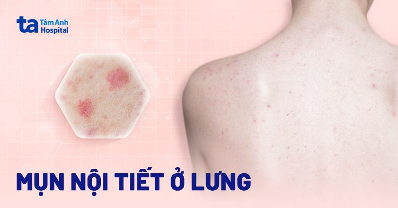 Giảm mụn hiệu quả với trái mận